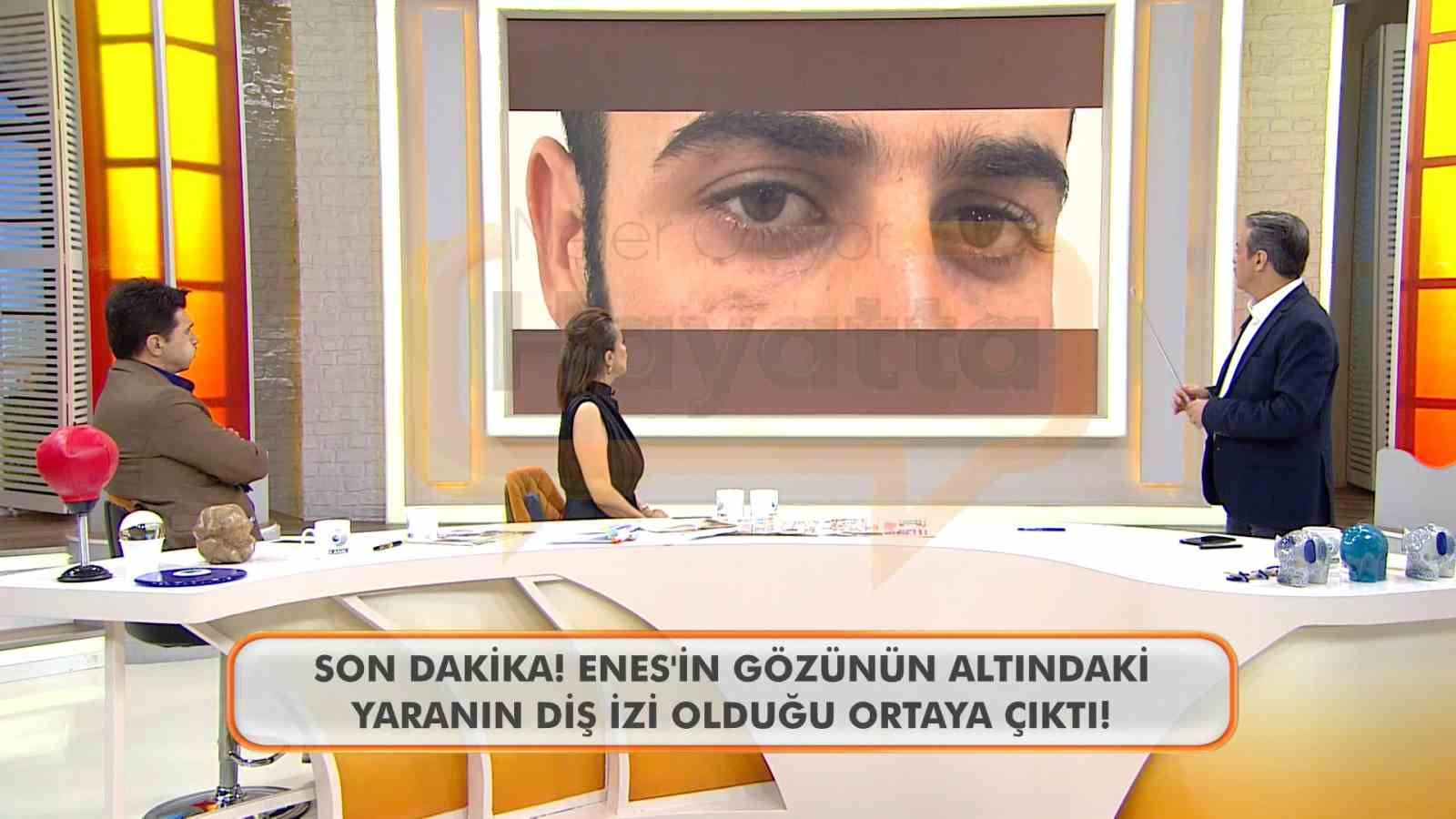 Canlı yayında Enes Güran’ın gözünün altındaki diş izine dikkat çekildi
?v=1